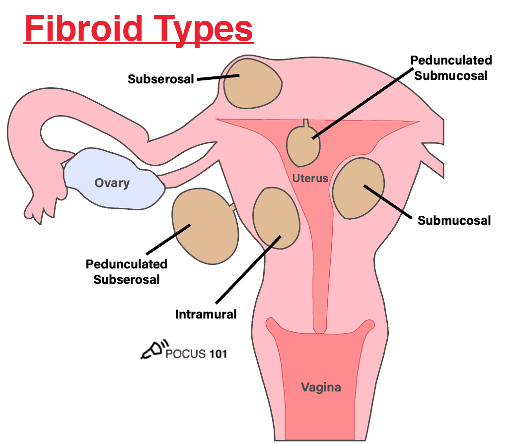Gynecology Pelvic Ultrasound Made Easy Step By Step Guide POCUS 101