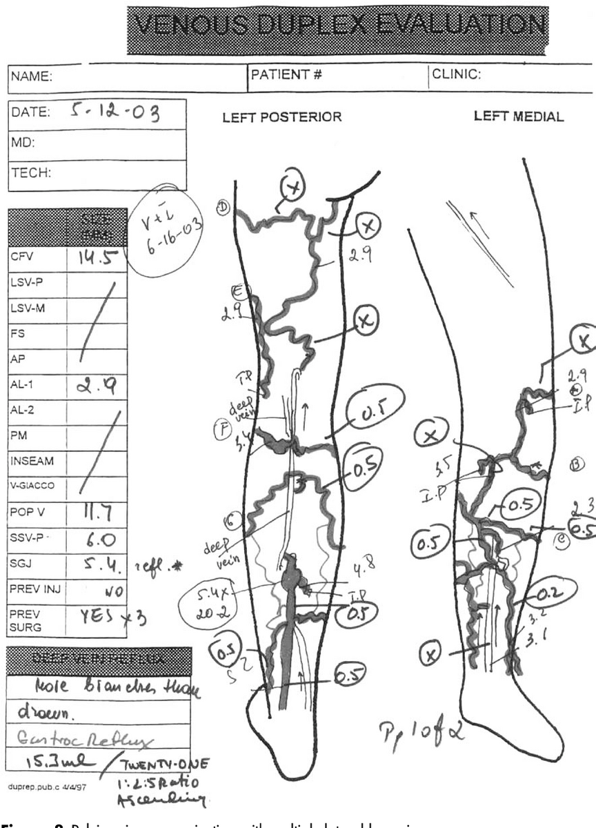 Management Of Venous Malformations In Klippel Trenaunay Syndrome With Ultrasound guided Foam Sclerotherapy Semantic Scholar